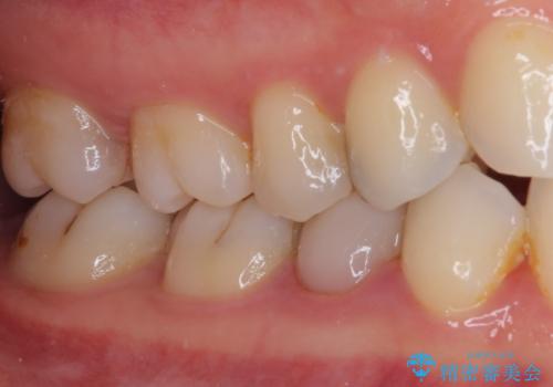 欠けてしまったプラスチック オールセラミッククラウンで土台の歯を守るの治療前