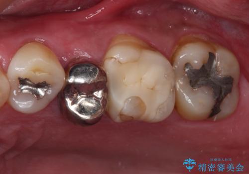 詰め物の外れてしまった奥歯　部分矯正で歯列を整えてから補綴治療の治療前