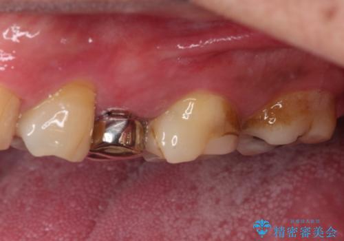 詰め物の外れてしまった奥歯 部分矯正で歯列を整えてから補綴治療の治療前