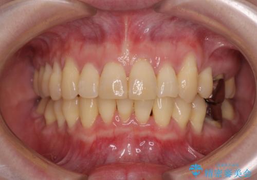 八重歯と先天欠損の歯列　ワイヤー矯正ですっきりとの症例 治療後