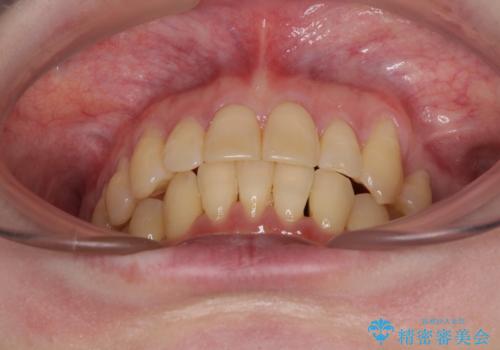 八重歯と先天欠損の歯列 ワイヤー矯正ですっきりとの治療後