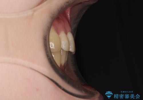 八重歯と先天欠損の歯列 ワイヤー矯正ですっきりとの治療後