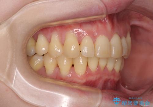 八重歯と先天欠損の歯列　ワイヤー矯正ですっきりとの治療後
