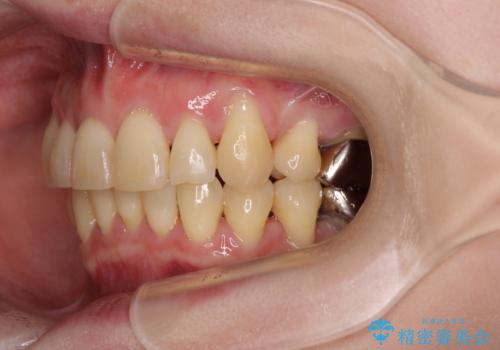 八重歯と先天欠損の歯列 ワイヤー矯正ですっきりとの治療後