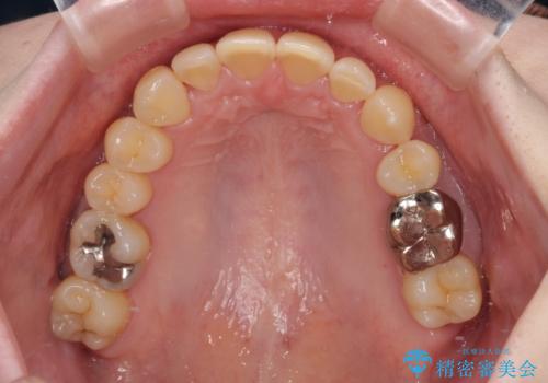 八重歯と先天欠損の歯列 ワイヤー矯正ですっきりとの治療後