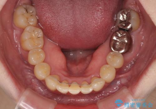 八重歯と先天欠損の歯列 ワイヤー矯正ですっきりとの治療後