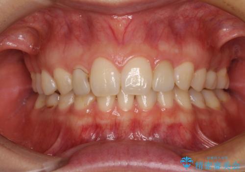 境目が目立つラミネートベニアを作り替えの治療前