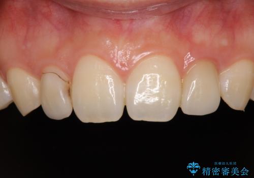 境目が目立つラミネートベニアを作り替えの症例 治療前