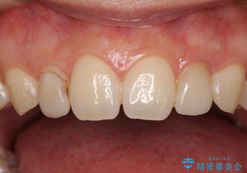 境目が目立つラミネートベニアを作り替えの治療前
