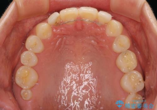 境目が目立つラミネートベニアを作り替えの治療前