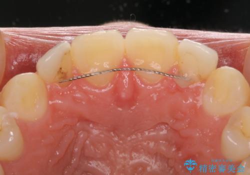 境目が目立つラミネートベニアを作り替えの治療前
