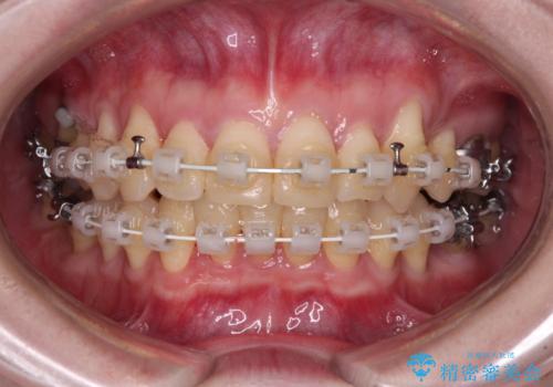八重歯と先天欠損の歯列 ワイヤー矯正ですっきりとの治療中