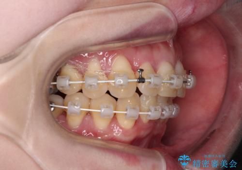 八重歯と先天欠損の歯列　ワイヤー矯正ですっきりとの治療中