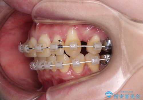 八重歯と先天欠損の歯列 ワイヤー矯正ですっきりとの治療中