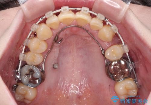 八重歯と先天欠損の歯列 ワイヤー矯正ですっきりとの治療中
