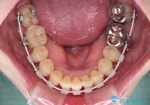 八重歯と先天欠損の歯列 ワイヤー矯正ですっきりとの治療中