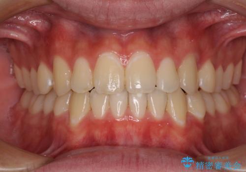 受け口傾向の咬み合わせ インビザラインできれいな口元にの症例 治療後