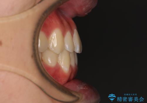 受け口傾向の咬み合わせ インビザラインできれいな口元にの治療後