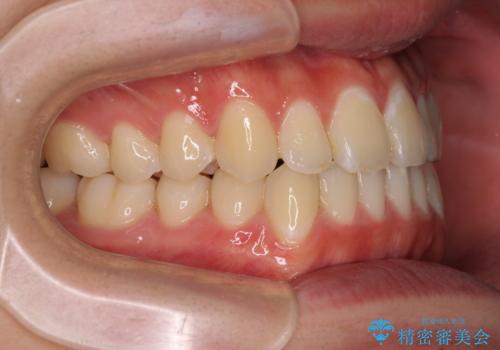 受け口傾向の咬み合わせ インビザラインできれいな口元にの治療後