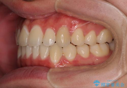 受け口傾向の咬み合わせ インビザラインできれいな口元にの治療後