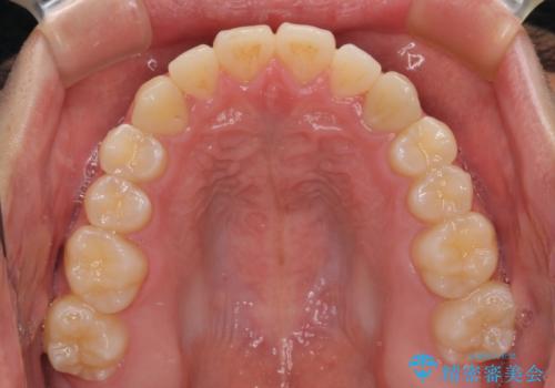 受け口傾向の咬み合わせ インビザラインできれいな口元にの治療後
