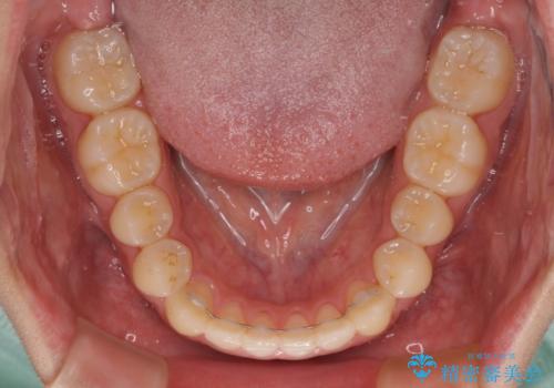 受け口傾向の咬み合わせ インビザラインできれいな口元にの治療後