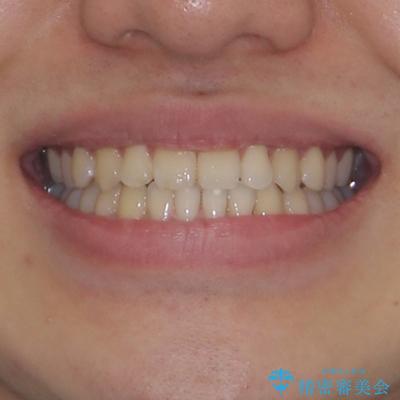 受け口傾向の咬み合わせ インビザラインできれいな口元にの治療後(顔貌)