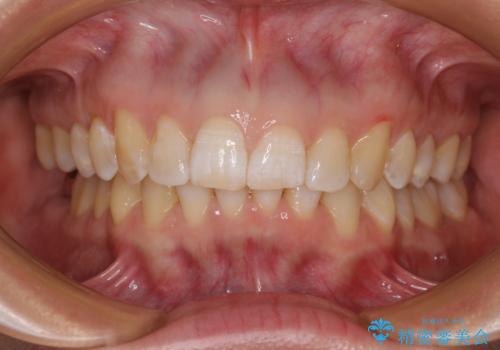 カリエール・ディスタライザーとインビザラインを用いた前歯の咬み合わせ改善の治療後