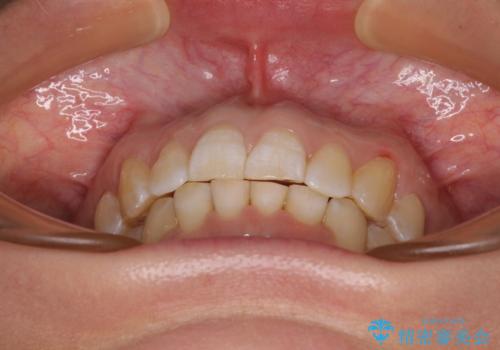 カリエール・ディスタライザーとインビザラインを用いた前歯の咬み合わせ改善の治療後