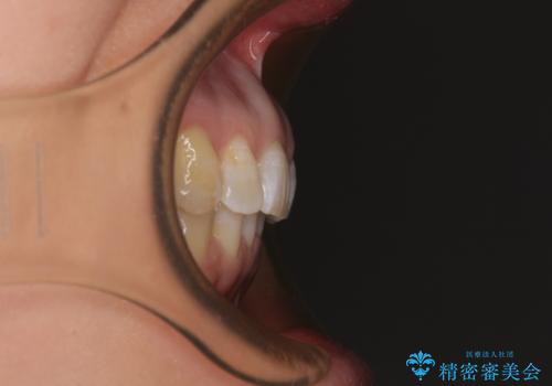 カリエール・ディスタライザーとインビザラインを用いた前歯の咬み合わせ改善の治療後