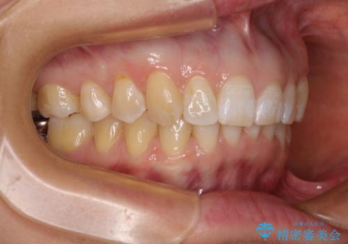 カリエール・ディスタライザーとインビザラインを用いた前歯の咬み合わせ改善の治療後