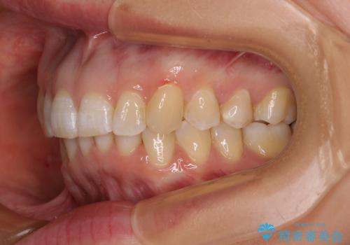 カリエール・ディスタライザーとインビザラインを用いた前歯の咬み合わせ改善の治療後