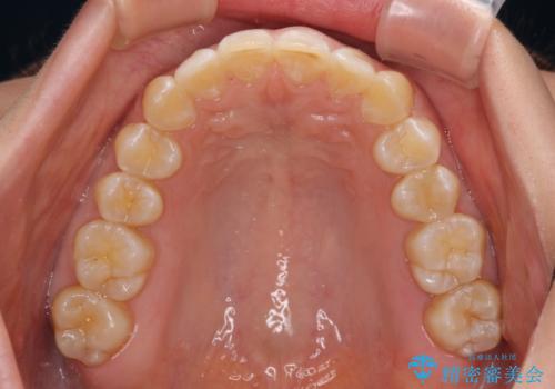 カリエール・ディスタライザーとインビザラインを用いた前歯の咬み合わせ改善の治療後