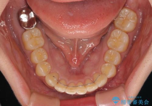 カリエール・ディスタライザーとインビザラインを用いた前歯の咬み合わせ改善の治療後