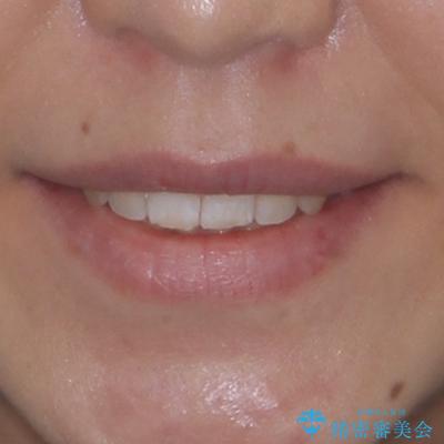 カリエール・ディスタライザーとインビザラインを用いた前歯の咬み合わせ改善の治療後(顔貌)