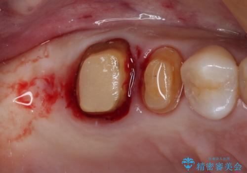 奥歯のセラミックがすぐに壊れる　欠損した奥歯へのインプラント治療の治療中