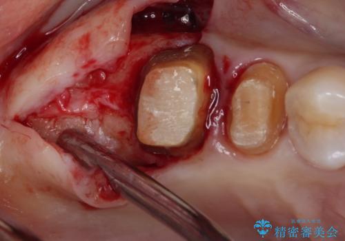 奥歯のセラミックがすぐに壊れる　欠損した奥歯へのインプラント治療の治療前