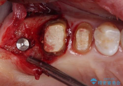 奥歯のセラミックがすぐに壊れる　欠損した奥歯へのインプラント治療の治療中