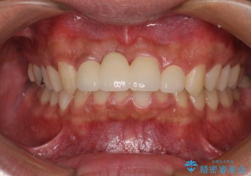 転んでぶつけて抜歯 前歯のオールセラミックブリッジの治療後