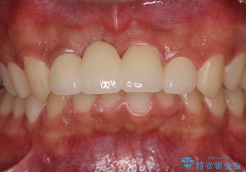 転んでぶつけて抜歯 前歯のオールセラミックブリッジの治療後