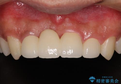 転んでぶつけて抜歯 前歯のオールセラミックブリッジの治療後