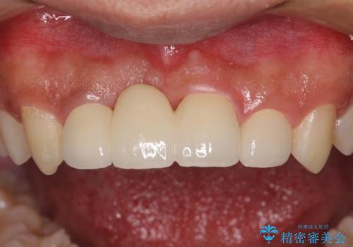転んでぶつけて抜歯 前歯のオールセラミックブリッジの治療後