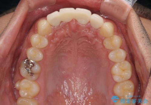 転んでぶつけて抜歯 前歯のオールセラミックブリッジの治療後