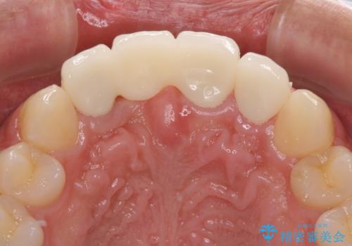 転んでぶつけて抜歯 前歯のオールセラミックブリッジの治療後