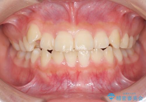 インビザラインで行う八重歯の治療の治療前