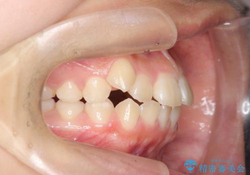 インビザラインで行う八重歯の治療の治療前