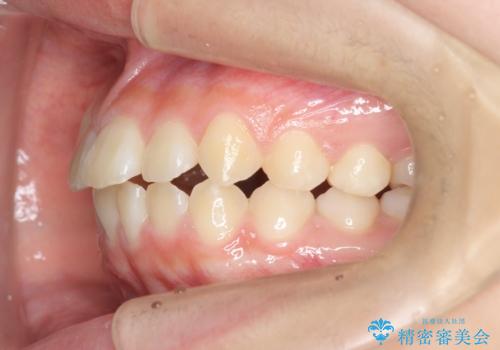 インビザラインで行う八重歯の治療の治療前