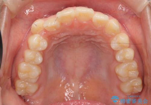 インビザラインで行う八重歯の治療の治療前
