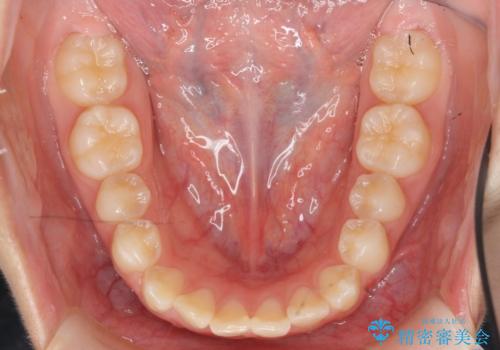 インビザラインで行う八重歯の治療の治療前