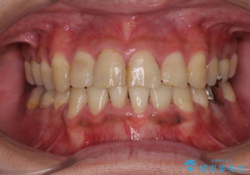 重なって磨きにくい上下の前歯 ワイヤー装置での抜歯矯正の治療後